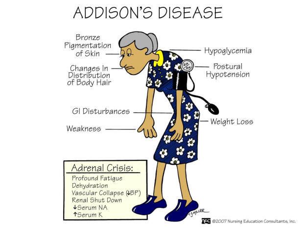 Addison s Disease RMI